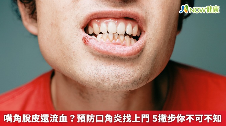 嘴角脫皮還流血?預防口角炎找上門 5撇步你不可不知 嘴角脫皮還流血?預防口角炎找上門 5撇步你不可不知