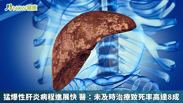 猛爆性肝炎病程進展快 醫:未及時治療致死率高達8成 猛爆性肝炎病程進展快 醫:未及時治療致死率高達8成