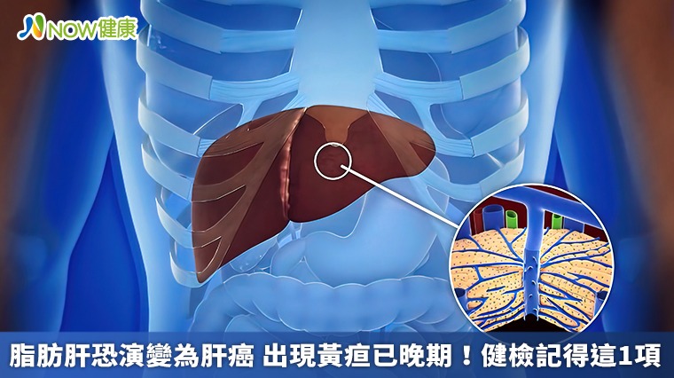 脂肪肝恐演變為肝癌 出現黃疸已晚期！健檢記得這1項