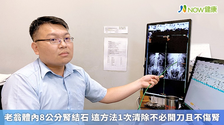 老翁體內8公分腎結石 這方法1次清除不必開刀且不傷腎 老翁體內8公分腎結石 這方法1次清除不必開刀且不傷腎