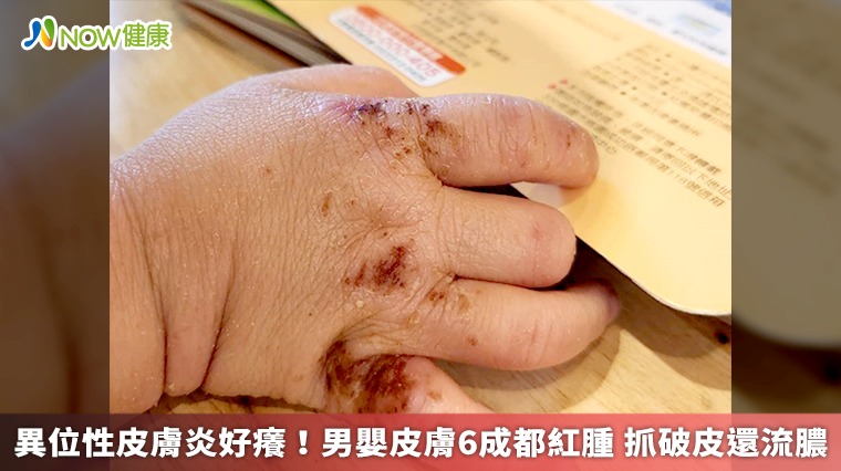 異位性皮膚炎好癢!男嬰皮膚6成都紅腫 抓破皮還流膿 異位性皮膚炎好癢!男嬰皮膚6成都紅腫 抓破皮還流膿