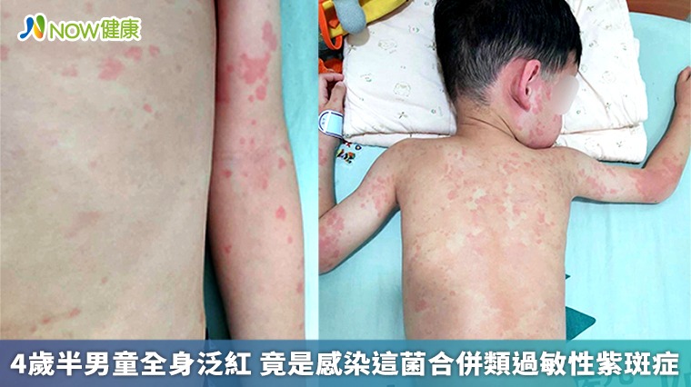 4歲半男童全身泛紅 竟是感染這菌合併類過敏性紫斑症 4歲半男童全身泛紅 竟是感染這菌合併類過敏性紫斑症