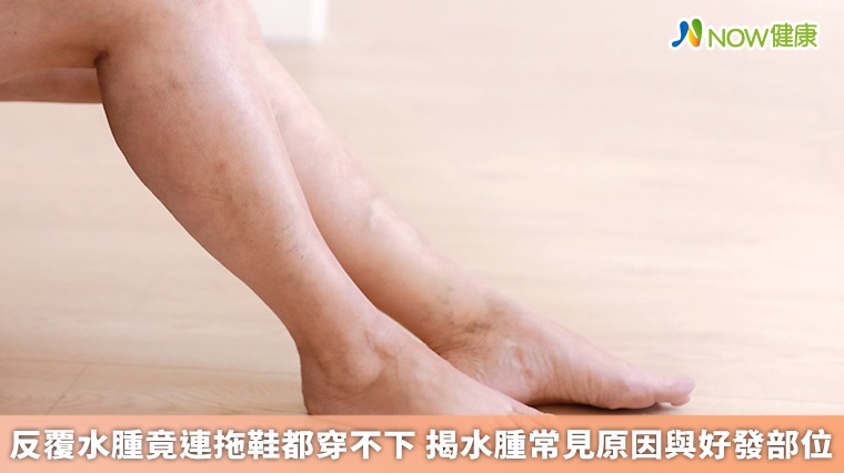 反覆水腫竟連拖鞋都穿不下 揭水腫常見原因與好發部位 