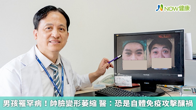 男孩罹罕病！帥臉變形萎縮 醫：恐是自體免疫攻擊釀禍