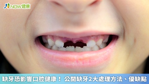 缺牙恐影響口腔健康！ 公開缺牙2大處理方法、優缺點