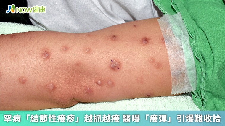 罕病「結節性癢疹」越抓越癢 醫曝「癢彈」引爆難收拾 罕病「結節性癢疹」越抓越癢 醫曝「癢彈」引爆難收拾