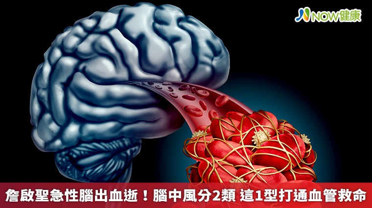 詹啟聖急性腦出血逝!腦中風分2類 這1型打通血管救命 詹啟聖急性腦出血逝!腦中風分2類 這1型打通血管救命