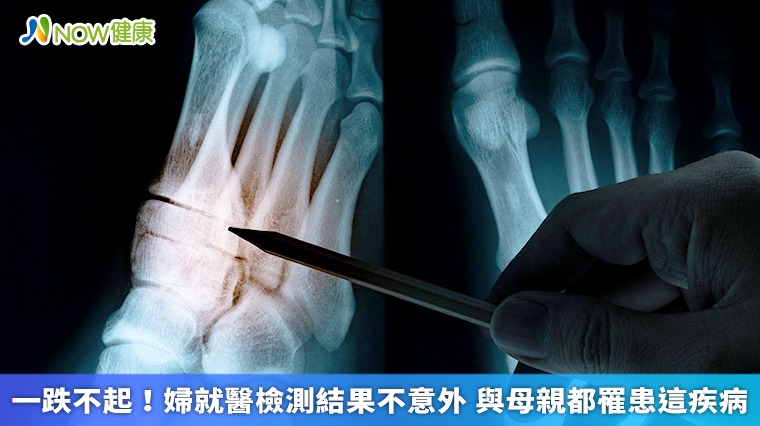 一跌不起!婦就醫檢測結果不意外 與母親都罹患這疾病 一跌不起!婦就醫檢測結果不意外 與母親都罹患這疾病