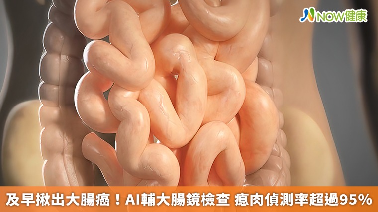 及早揪出大腸癌！AI輔大腸鏡檢查 瘜肉偵測率超過95％