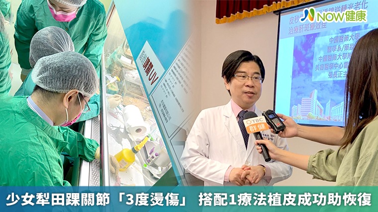 少女犁田踝關節「3度燙傷」 搭配1療法植皮成功助恢復 少女犁田踝關節「3度燙傷」 搭配1療法植皮成功助恢復