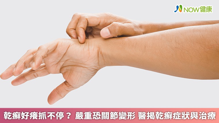 乾癬好癢抓不停？嚴重恐關節變形 醫揭乾癬症狀與治療