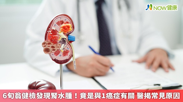 6旬翁健檢發現腎水腫!竟是與1癌症有關 醫揭常見原因 6旬翁健檢發現腎水腫!竟是與1癌症有關 醫揭常見原因