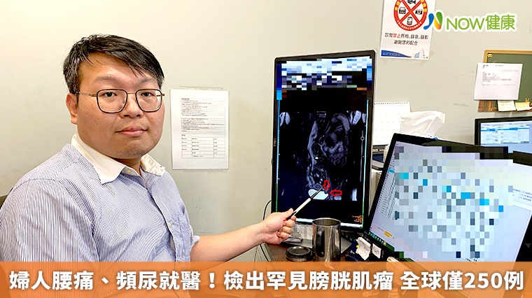 婦人腰痛、頻尿就醫!檢出罕見膀胱肌瘤 全球僅250例 婦人腰痛、頻尿就醫!檢出罕見膀胱肌瘤 全球僅250例