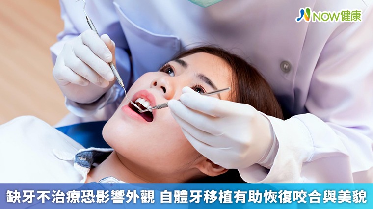 缺牙不治療恐影響外觀 自體牙移植有助恢復咬合與美貌 缺牙不治療恐影響外觀 自體牙移植有助恢復咬合與美貌