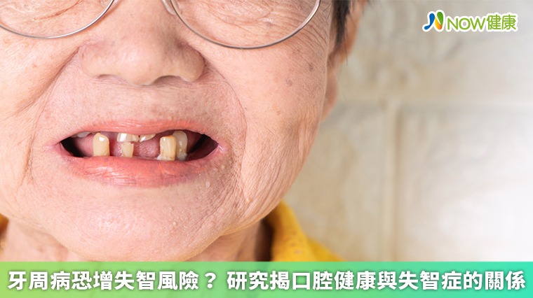 牙周病恐增失智風險? 研究揭口腔健康與失智症的關係 牙周病恐增失智風險? 研究揭口腔健康與失智症的關係