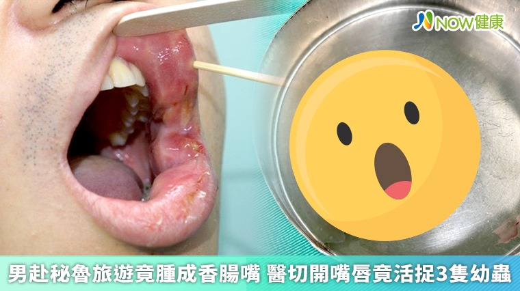 男赴秘魯旅遊腫成香腸嘴! 醫切開嘴唇竟活捉3隻幼蟲 男赴秘魯旅遊腫成香腸嘴! 醫切開嘴唇竟活捉3隻幼蟲
