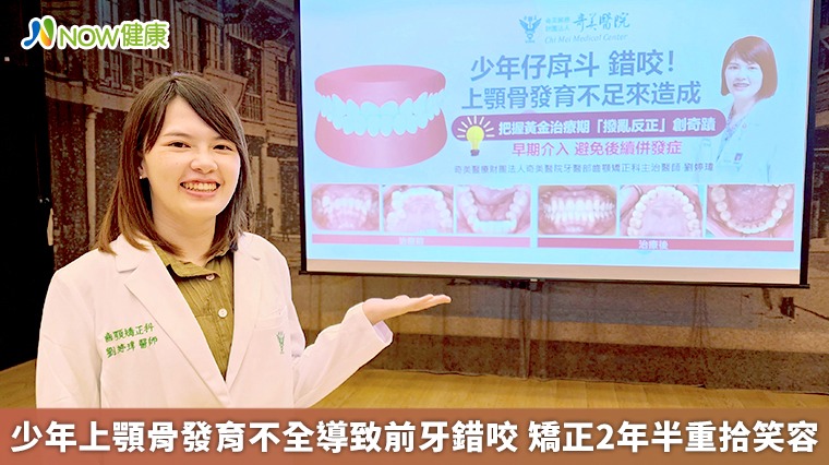 少年上顎骨發育不全導致前牙錯咬 矯正2年半重拾笑容 少年上顎骨發育不全導致前牙錯咬 矯正2年半重拾笑容