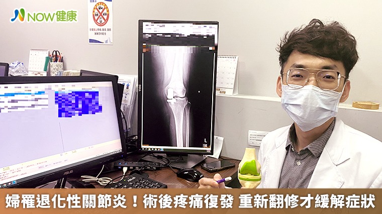 婦罹退化性關節炎!術後疼痛復發 重新翻修才緩解症狀 婦罹退化性關節炎!術後疼痛復發 重新翻修才緩解症狀