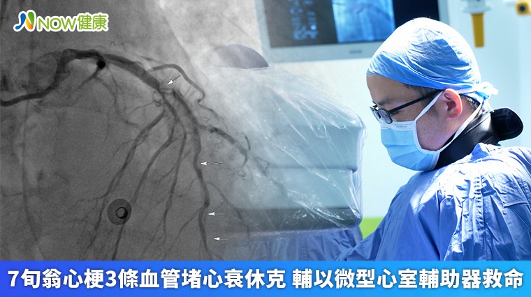 7旬翁心梗3條血管堵心衰休克 輔以微型心室輔助器救命 7旬翁心梗3條血管堵心衰休克 輔以微型心室輔助器救命