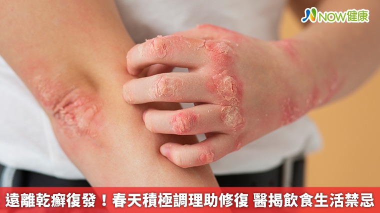 遠離乾癬復發!春天積極調理助修復 醫揭飲食生活禁忌 遠離乾癬復發!春天積極調理助修復 醫揭飲食生活禁忌