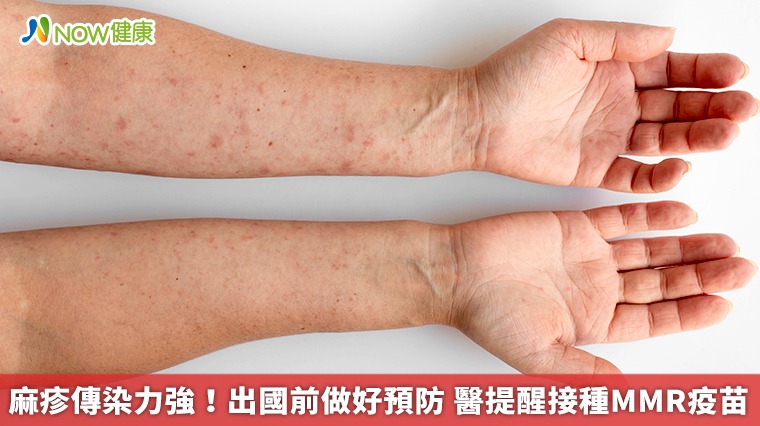 麻疹傳染力強!出國前做好預防 醫提醒接種MMR疫苗 麻疹傳染力強!出國前做好預防 醫提醒接種MMR疫苗