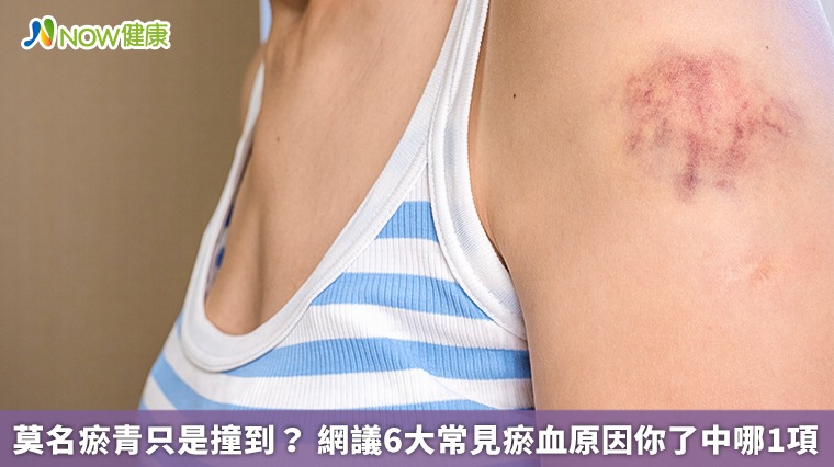 莫名瘀青只是撞到? 網議6大常見瘀血原因你了中哪1項 莫名瘀青只是撞到? 網議6大常見瘀血原因你了中哪1項