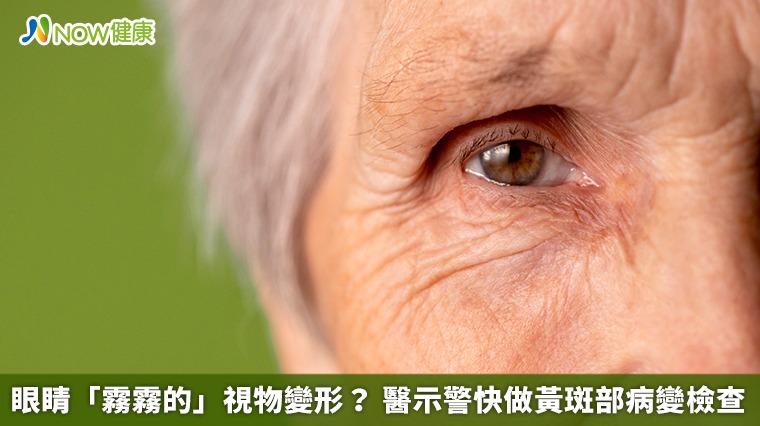 眼睛「霧霧的」視物變形? 醫示警快做黃斑部病變檢查 眼睛「霧霧的」視物變形? 醫示警快做黃斑部病變檢查