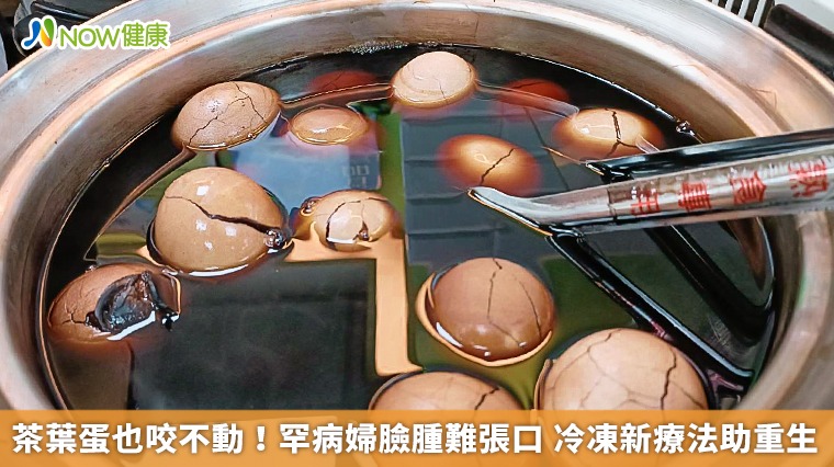 茶葉蛋也咬不動!罕病婦臉腫難張口 冷凍新療法助重生 茶葉蛋也咬不動!罕病婦臉腫難張口 冷凍新療法助重生