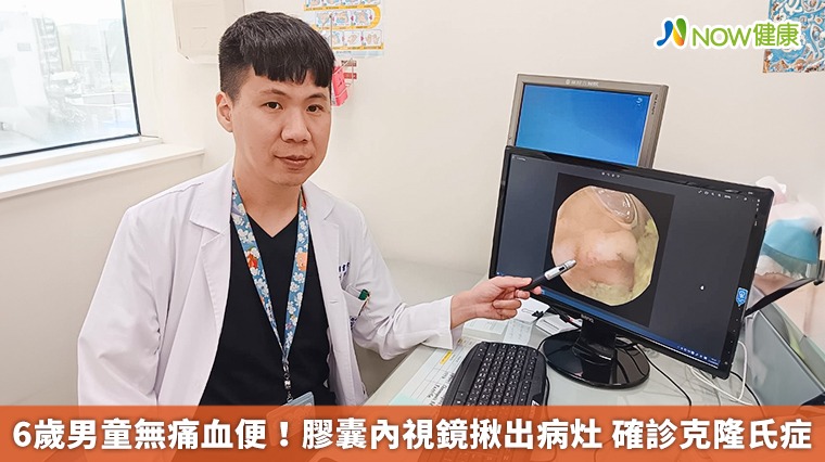 6歲男童無痛血便!膠囊內視鏡揪出病灶 確診克隆氏症 6歲男童無痛血便!膠囊內視鏡揪出病灶 確診克隆氏症