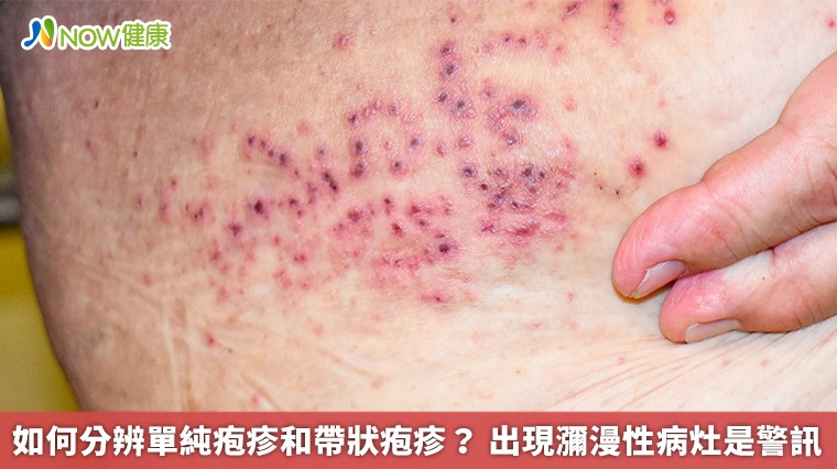 如何分辨單純疱疹和帶狀疱疹? 出現瀰漫性病灶是警訊 如何分辨單純疱疹和帶狀疱疹? 出現瀰漫性病灶是警訊