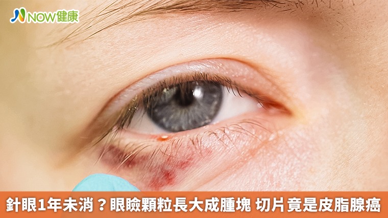 針眼1年未消?眼瞼顆粒長大成腫塊 切片竟是皮脂腺癌 針眼1年未消?眼瞼顆粒長大成腫塊 切片竟是皮脂腺癌