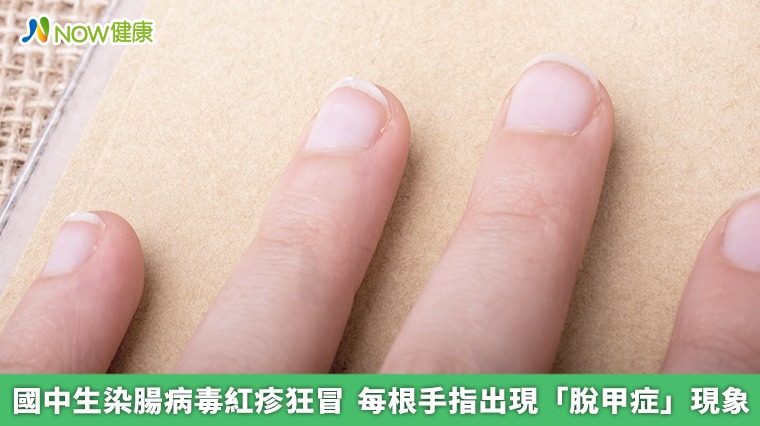國中生染腸病毒紅疹狂冒 每根手指出現「脫甲症」現象 國中生染腸病毒紅疹狂冒 每根手指出現「脫甲症」現象