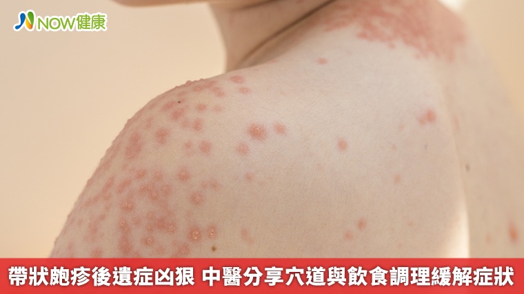帶狀皰疹後遺症凶狠 中醫分享穴道與飲食調理緩解症狀 帶狀皰疹後遺症凶狠 中醫分享穴道與飲食調理緩解症狀