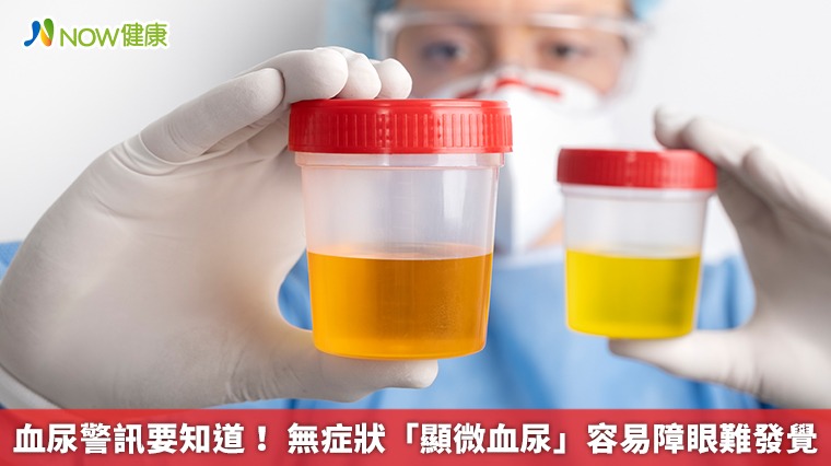 血尿警訊要知道! 無症狀「顯微血尿」容易障眼難發覺 血尿警訊要知道! 無症狀「顯微血尿」容易障眼難發覺