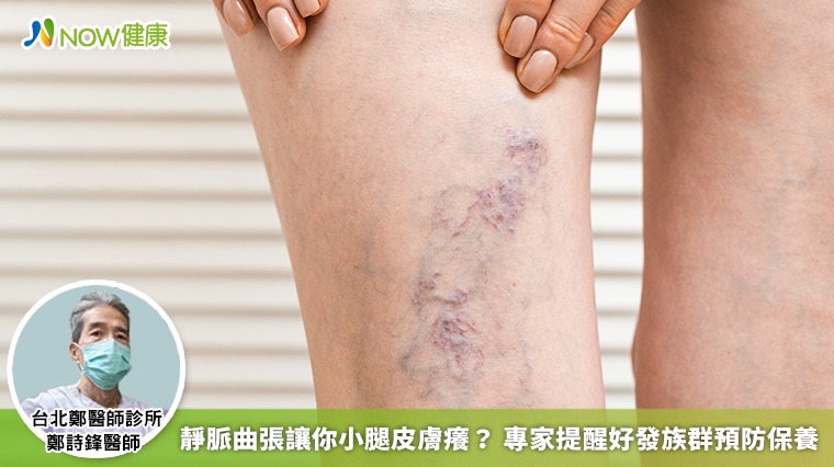 靜脈曲張讓你小腿皮膚癢? 專家提醒好發族群預防保養 靜脈曲張讓你小腿皮膚癢? 專家提醒好發族群預防保養