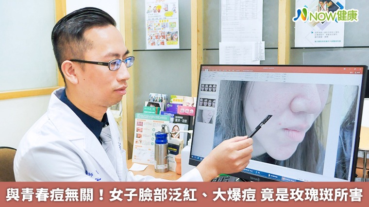 與青春痘無關!女子臉部泛紅、大爆痘 竟是玫瑰斑所害 與青春痘無關!女子臉部泛紅、大爆痘 竟是玫瑰斑所害