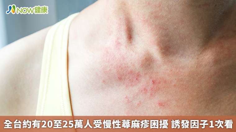 全台約有20至25萬人受慢性蕁麻疹困擾 誘發因子1次看 全台約有20至25萬人受慢性蕁麻疹困擾 誘發因子1次看