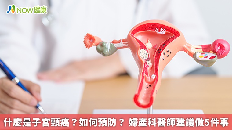 什麼是子宮頸癌?如何預防? 婦產科醫師建議做5件事 什麼是子宮頸癌?如何預防? 婦產科醫師建議做5件事