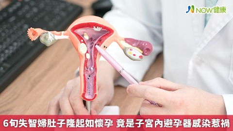 6旬失智婦肚子隆起如懷孕  竟是子宮內避孕器感染惹禍