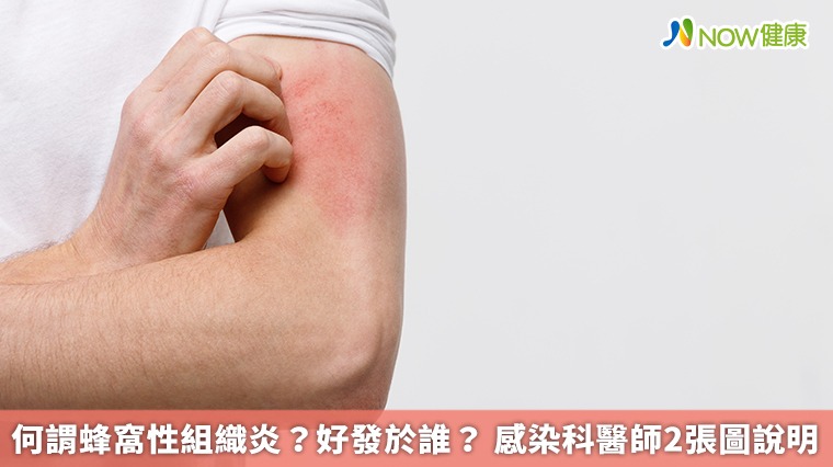 何謂蜂窩性組織炎?好發於誰? 感染科醫師2張圖說明 何謂蜂窩性組織炎?好發於誰? 感染科醫師2張圖說明