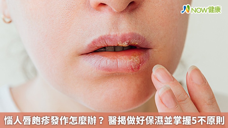 惱人唇皰疹發作怎麼辦? 醫揭做好保濕並掌握5不原則 惱人唇皰疹發作怎麼辦? 醫揭做好保濕並掌握5不原則