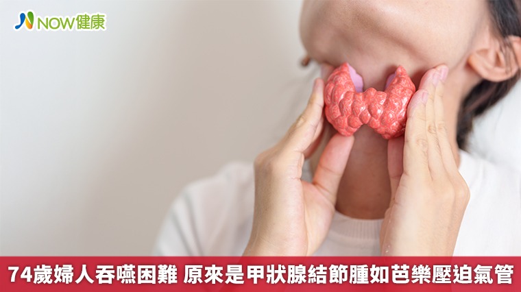 74歲婦人吞嚥困難 原來是甲狀腺結節腫如芭樂壓迫氣管 74歲婦人吞嚥困難 原來是甲狀腺結節腫如芭樂壓迫氣管