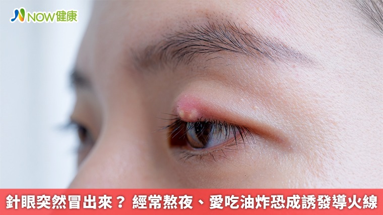 針眼突然冒出來? 經常熬夜、愛吃油炸恐成誘發導火線 針眼突然冒出來? 經常熬夜、愛吃油炸恐成誘發導火線