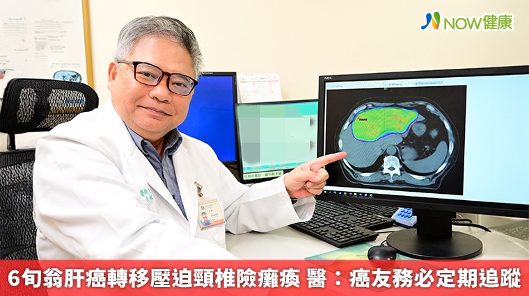 6旬翁肝癌轉移壓迫頸椎險癱瘓 醫:癌友務必定期追蹤 6旬翁肝癌轉移壓迫頸椎險癱瘓 醫:癌友務必定期追蹤