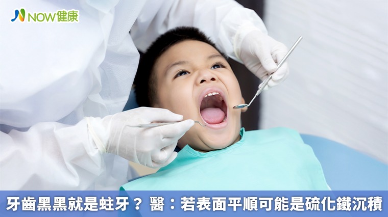 牙齒黑黑就是蛀牙? 醫:若表面平順可能是硫化鐵沉積 牙齒黑黑就是蛀牙? 醫:若表面平順可能是硫化鐵沉積