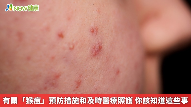 有關「猴痘」預防措施和及時醫療照護 你該知道這些事 有關「猴痘」預防措施和及時醫療照護 你該知道這些事