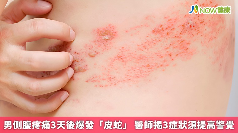 男側腹疼痛3天後爆發「皮蛇」 醫師揭3症狀須提高警覺