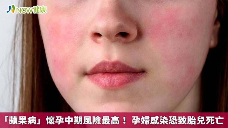 「蘋果病」懷孕中期風險最高! 孕婦感染恐致胎兒死亡 「蘋果病」懷孕中期風險最高! 孕婦感染恐致胎兒死亡