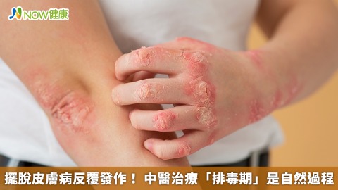 擺脫皮膚病反覆發作！ 中醫治療「排毒期」是自然過程