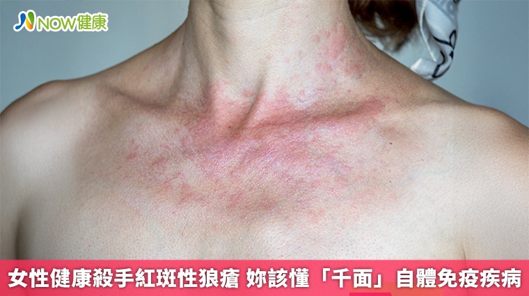 女性健康殺手紅斑性狼瘡 妳該懂「千面」自體免疫疾病